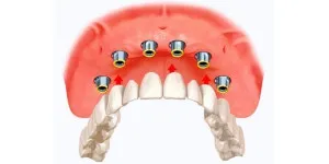 Failure-of-zirconia-prosthesis