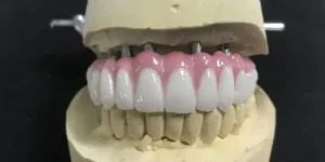 Importance to Restore your bite